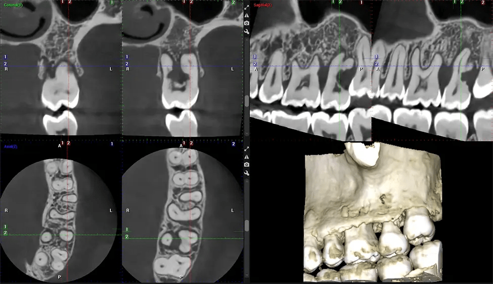 Planmeca CBCT Low Radiation G7 Endodontic Study Miami