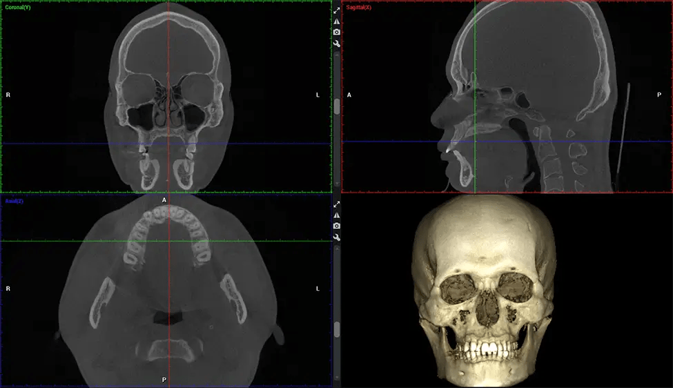 Planmeca CBCT G7 de baja radiación Imágenes de cráneo completo Miami